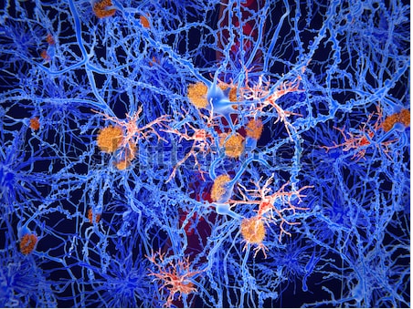 En orange, les plaques amyloïdes