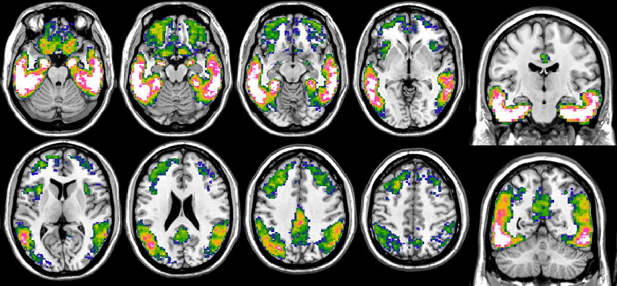 Imagerie de cerveaux de patients atteints de la maladie d'Alzheimer
