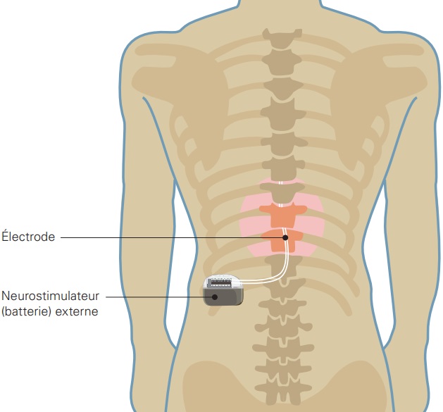implantation électrodes