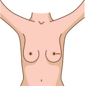 La nipple sparing mastectomy - incision sur le côté depuis l’aréole