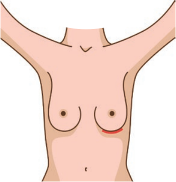 La nipple sparing mastectomy - incision sous le sein