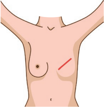mastectomie simple