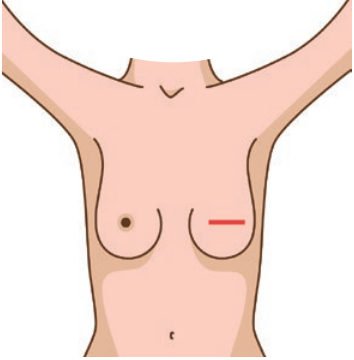 La skin sparing mastectomy: