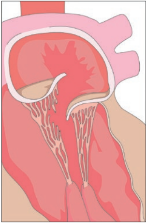 Atteinte dégénérative