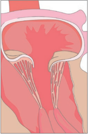 Atteinte fonctionnelle