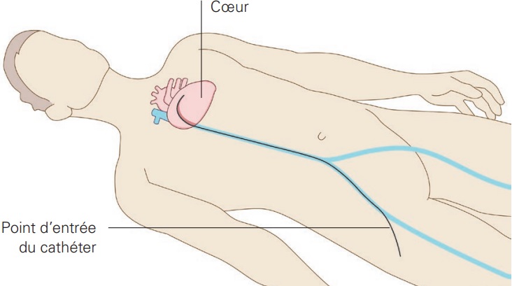 cathéter est introduit par la veine fémorale