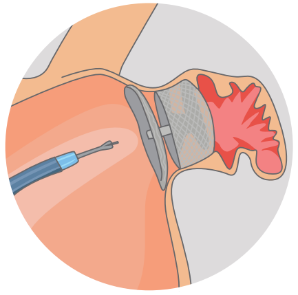 Dispositif déployé dans l’auricule