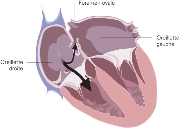 foramen ovale perméable