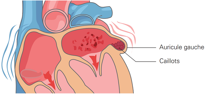 Les oreillettes du cœur en fibrillation auriculaire et la formation de caillots.