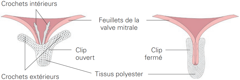 Valve mitrale clipée