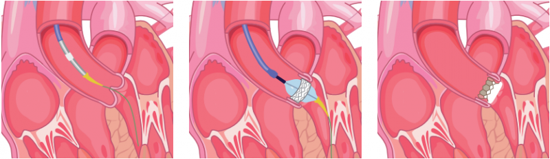 Remplacement valve aortique : Quand faut-il le faire ?