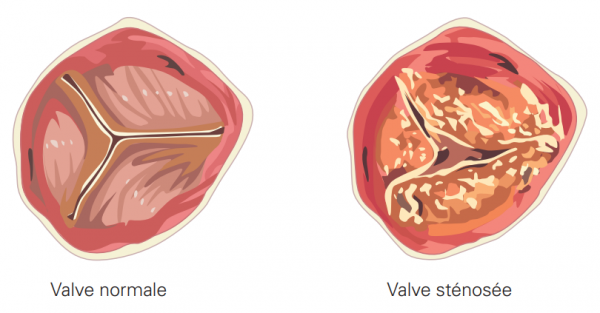 valve normale et valve sténosée