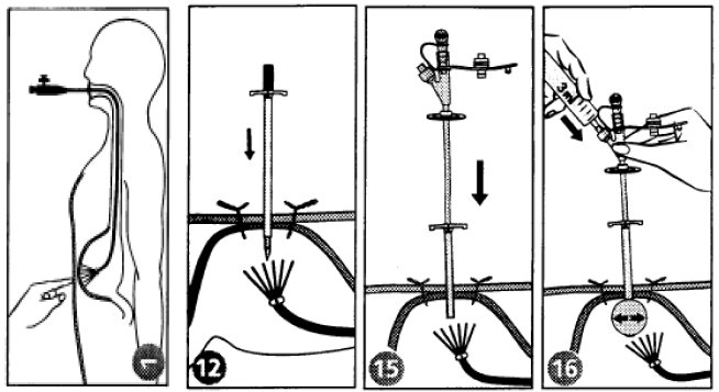 Pose à travers la paroi abdominale sous contrôle endoscopique (méthode « push-PEG »)