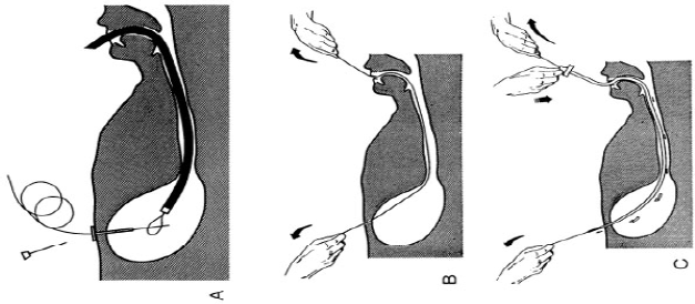 Pose de la sonde par la bouche (méthode « pull-through »)