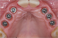 Etape 1: des implants dentaires ont été insérés  pour remplacer des dents perdues