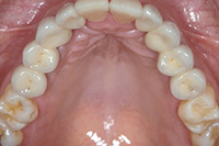 Etape 3: les dents en céramique ont été fixées