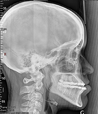 Diagnostic avant l'intervention: malposition des mâchoires