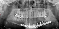 Chirurgie reconstructive maxillo-mandibulaire