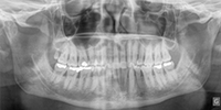 Chirurgie reconstructive maxillo-mandibulaire
