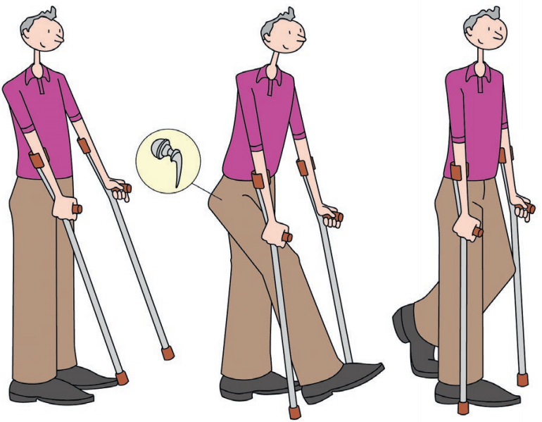 Top 10+ combien de temps pour marcher normalement après prothèse de hanche
