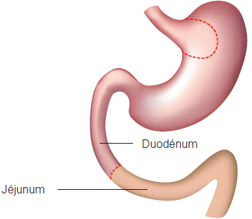 Illustration of the Gastric by pass technique
