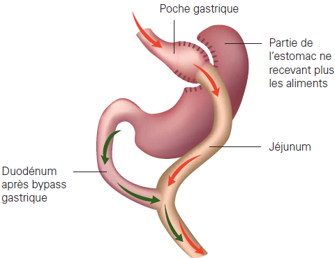 Illustration of the Gastric by pass technique