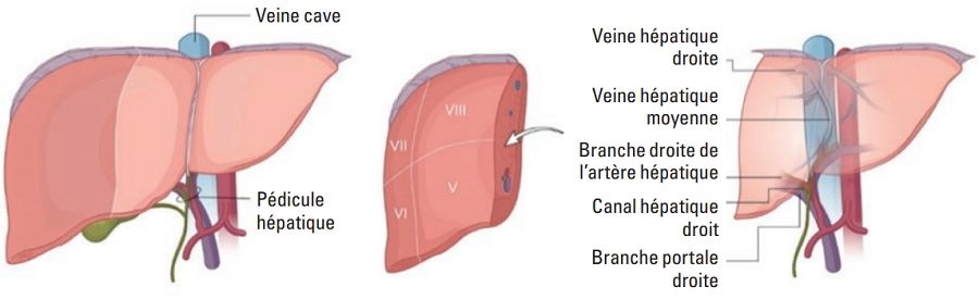 L’hépatectomie droite
