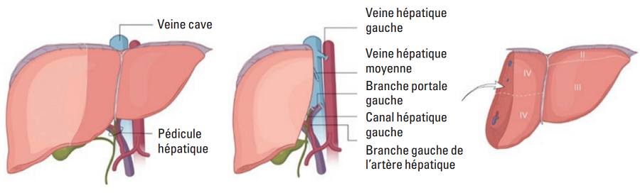 hépatectomie gauche