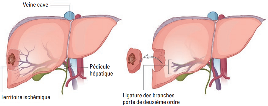 résection anatomique