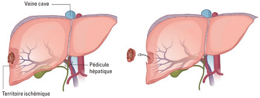 résection non anatomique