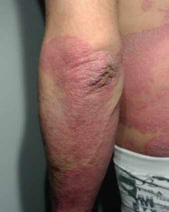 Psoriasis en plaques