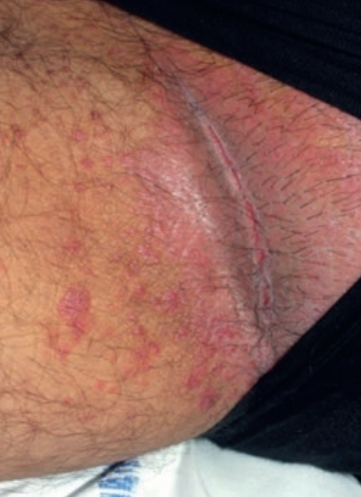 Psoriasis inversé 