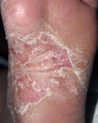 Le psoriasis palmo-plantaire