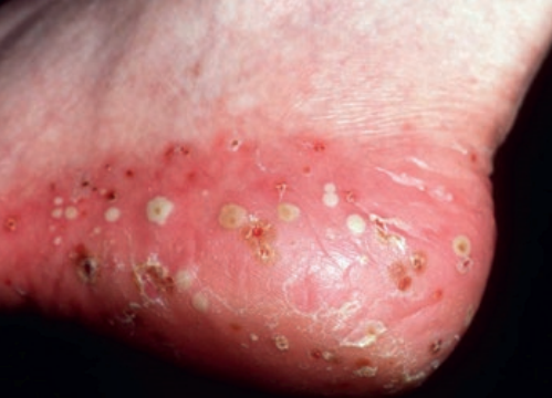 Psoriasis pustuleux