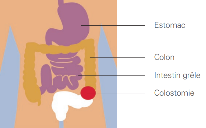colostomie