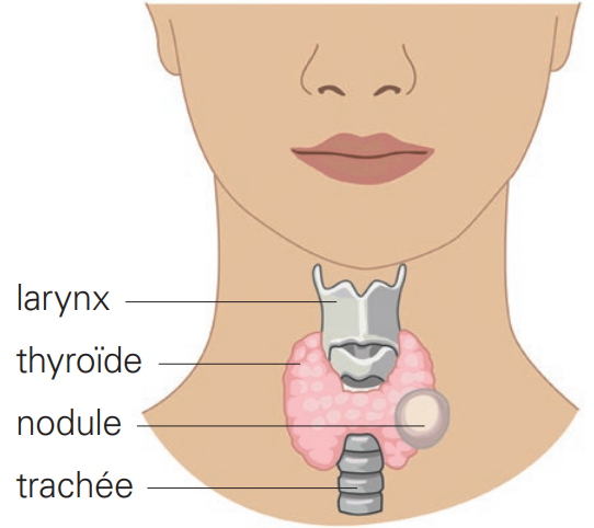 nodule thyroïdien
