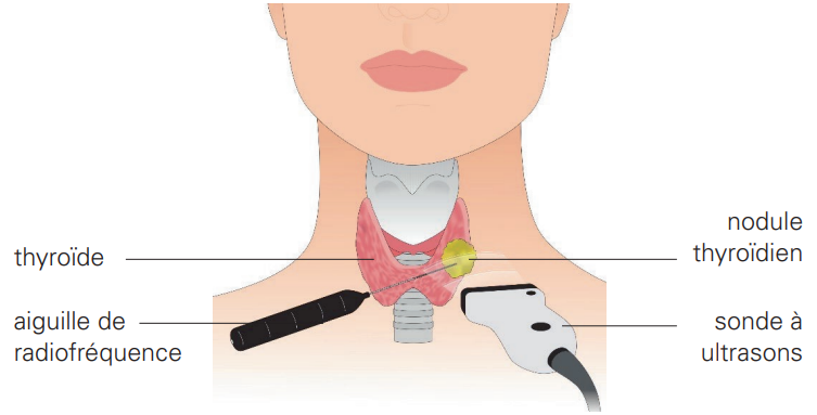 thermoablation par radiofréquence