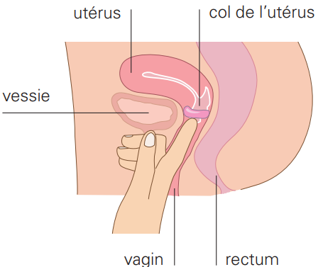 pose d'un pessaire -étape 5