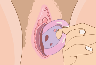 retrait d'un pessaire - étape 4