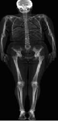 [img]Image Examen densitométrique osseux (corps entier)[/img]