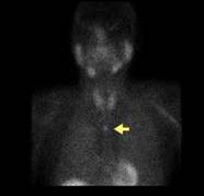 [img]Image Scintigraphie des glandes parathyroïdes[/img]