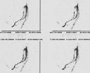 [img]Image Lymphoscintigraphie des ganglions sentinelles mélanome[/img]