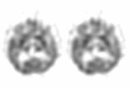 [img]Image Scintigraphie SPECT de perfusion cérébral à ECD[/img]