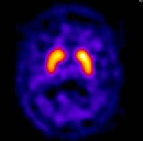 [img]Image Scintigraphie SPECT cérébral au I-123 DATSCAN[/img]
