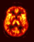 [img]Image Examen PET/CT cérébral FDG[/img]
