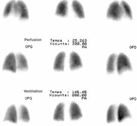 [img]Image Scintigraphie pulmonaire ventilation/perfusion[/img]