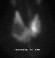 [img]Image Scintigraphie thyroïdienne au Technetium-99m[/img]
