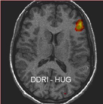 IRMf du langage : Activation du cortex frontal gauche lors d'une tâche de jugement catégoriel