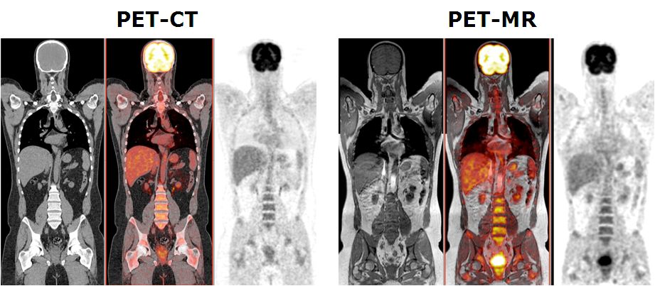 PET CT vs PET-MR
