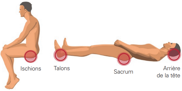 les parties du corps ou surviennent les escarres 